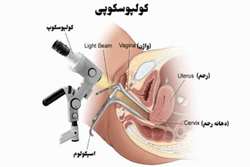کولپوسکوپی بانوان